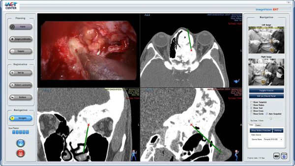 Skull base, ENT surgeries